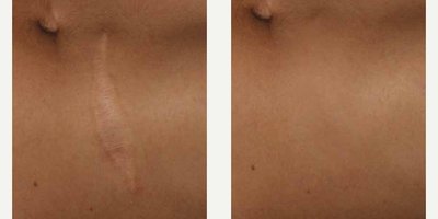 Woman treated with ResurFX - Photo provided courtesy of Lumenis, Ltd., performed by Matteo Tretti Clementoni, MD