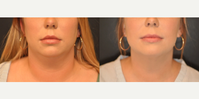 25-34 year old woman treated with Chin Liposuction - 25-34 year old woman treated with Chin Liposuction- 6 weeks post-op