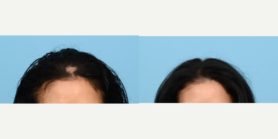 45-54 year old woman treated with PRP Injections, PRP for Hair Loss, Hair Loss Treatment - Goals: Fill in balding areas, add densityThis 46-year-old patient was hair loss at the top of his scalp due to an injury, and was concerned with overall hair density at the front. She needed a solution that didn't require daily maintenance, and per Dr. Wise's recommendation, she opted for three sessions of Platelet Rich Plasma therapy. Six months post-procedure, the patient is already seeing a lot more density and growth. Even more growth is expected over the next six months.