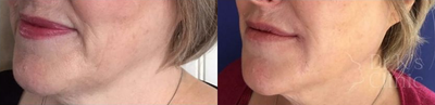 Woman treated with Aqualyx - Woman treated with Aqualyx (injectable double chin reduction)
