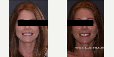 25-34 year old woman treated with Gum Lift - Gum Lift