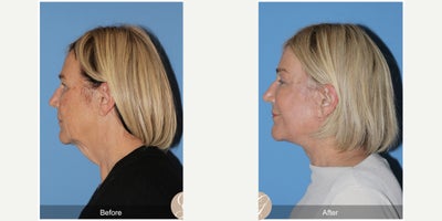 68 year old woman treated with Deep Plane Facelift, Neck Lift, Brow Lift, CO2 Laser, MACS Facelift - 68 year old woman treated with Deep Plane Face and Neck Lift, Temporal Brow Lift, CO2 Laser of Face, MAC