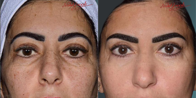 35-44 Years Old Woman Treated with Morpheus8 - As a result of Morpheus 8 device-assisted treatment, our female patient; was free from blemishes on her face and nose; so, the relevant picture, is in the appendix.