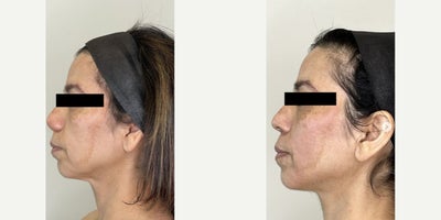 Woman treated with Morpheus8, Lumecca - After 3 sessions of Morpheus8 and 2 sessions of Lumecca, this transformation speaks for itself.