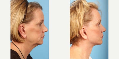 63 year old woman treated with Neck Lift - 63 year old woman treated with Facelift, limited Cheek Lift and Neck Lift with anterior platysmaplasty.