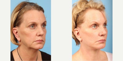 63 year old woman treated with Facelift - 63 year old woman treated with Facelift, limited Cheek Lift and Neck Lift with anterior platysmaplasty.