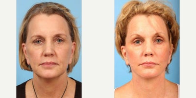 63 year old woman treated with Facelift - 63 year old woman treated with Facelift, limited Cheek Lift and Neck Lift with anterior platysmaplasty.