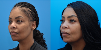 45-54 year old woman treated with Dermal Fillers, Chemical Peel, Skin Rejuvenation, Microdermabrasion - Patient is 1 month after undereye filler with Restylane and a series of chemical peels and microneedling.