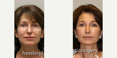Woman treated with Mini Facelift - Woman treated with Mini Facelift, Deep Plane Facelift, and Eyelid Surgery. Pre-op, patient was concerned that her face looked tired. She had a previous lower blepharoplasty but did not like the irregularities and shadows around her eyes along with the subtle jowls that were developing.