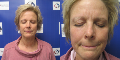 55-64 year old woman treated with Sylfirm X - Patient with hyperpigmentation and melasma, before and after 3 Sylfirm X microneedling treatments. After photo 1 month post procedure.