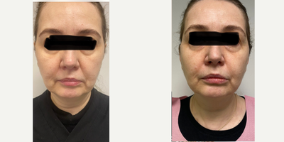 45-54 year old woman treated with Sofwave - One treatment full face and neck with no injections ever. Seelower eyelids, cheeks, jowls, neck wrinkles and contour.