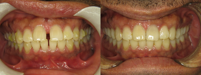 25-34 year old man treated with Clear Braces - Clear braces to align the teeth