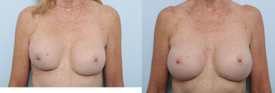 Strattice - Bilateral Breast Implant Exchange with Strattice