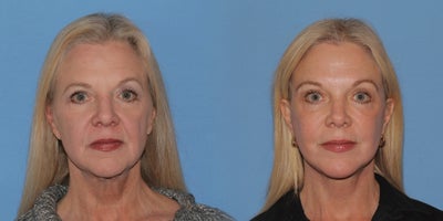 Woman treated with Deep Plane Facelift - Woman treated with Deep Plane Facelift