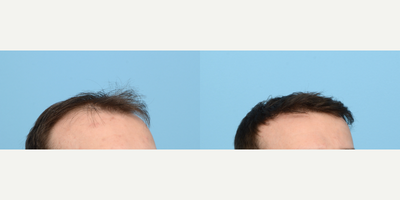 25-34 year old man treated with FUE Hair Transplant, Hair Transplant, Hair Loss Treatment, PRP for Hair Loss, NeoGraft, Low-Leve - This 28-year-old patient was experiencing thinning hair in his crown area and a receding hairline. Due to his family history of hair loss, he wanted to take action as it was progressively worsening. To rebuild hairline and add density to the crown, Dr. Wise performed an FUE hair transplant using 2,515 grafts. During the procedure, the patient also underwent PRP therapy to strengthen the follicles and expedite healing.