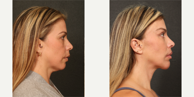 35-44 year old woman treated with Neck Lift, Eyelid Surgery, Brow Lift, Chin Implant - performed by Dr.Sozer