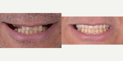 45-54 year old man treated with All-on-4 Dental Implants, Dental Implants, Full Mouth Reconstruction - This patient came to our office from USA was looking to regain his confidence and security, many dentists in the United States did not want to treat him and the costs were very high and did not give him options, we were able to place 4 dental implants and a reinforced acrylic prosthesis for greater durability and aesthetics.