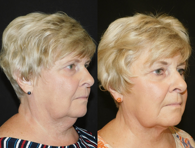 65-74 year old woman treated with CoolMini - Concern: Unwanted visible signs of fat on lower face