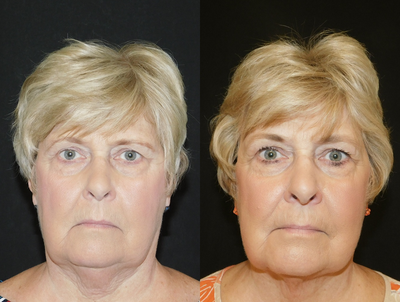68 year old woman treated with CoolMini - Concern: Unwanted visible signs of fat on lower face