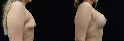 25-34 year old woman treated with Breast Implants - 28 yrs old womanCorrection of Tuberous Breast and augmentation450cc High Profile on the left and 385cc High profile on the rightIn these photos she is 1 month post-op