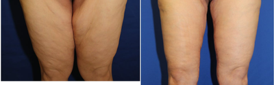 25-34 year old woman treated with Thigh Lift - This patient in her mid-20s lost over 120 pounds and was left with loose, wrinkly thigh skin. She underwent a thigh lift in Beverly Hills with Dr. Katzen to tighten her thighs. She is extremely happy with her results.