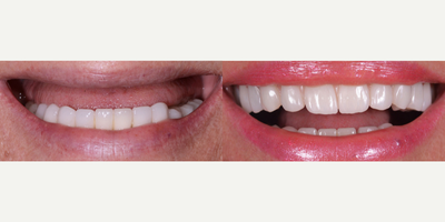 45-54 year old woman treated with Full Mouth Reconstruction - Upper Jaw Implants with 28 zirconium crowns ( 14 Upper jaw and 14 Lower Jaw)