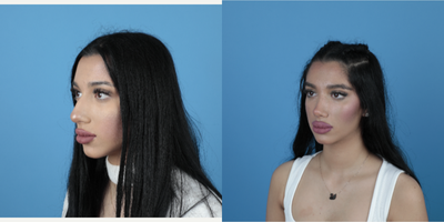 18-24 year old woman treated with Rhinoplasty - Piezo rhinoplasty