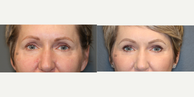 Stem cell rich fat transfer and laser. - Fat transfer to upper eyelids and face with laser treatment and scar treatment.