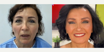 56 year old woman treated with Cheek Augmentation - 56 yearold woman treated with Cheek Augmentation through facial fat transfer as well as fat transfer to lips,Deep Plane Facelift,Neck Lift, Eyelid Surgery, Cheek Augmentation, Buccal Fat Removal, Brow Lift, and Cheek Lift. Patient felt very old and was concerned with the sagging of her face.