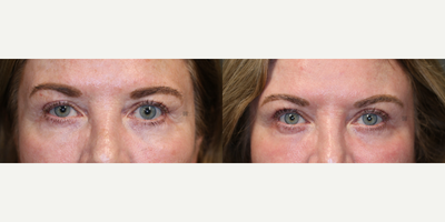 Upper Lid Ptosis Repair - Brow lift, fat transfer, laser