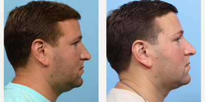 25-34 year old man treated with CoolMini, CoolSculpting, Ultherapy - In order to contour the lower face and eliminate his double chin, this patient underwent two CoolMini sessions and a single lower face Ultherapy treatment. Three months following the initial treatment, the patient observed significant improvement in the targeted areas.
