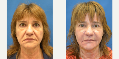 67 year old female treated with paranasal implants - This patient is shown 3 months after Omnipore paranasal implants. No other treatments were rendered.