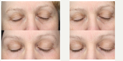 55-64 year old woman treated with ProFractional Laser - Eyes