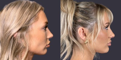 25-34 year old woman treated with Eyelid Surgery, CO2 Laser, ActiveFX - This 30 year old woman is 5'5 and 135 pounds. She presented requesting an eyelid lift. She had an upper eyelid blepharoplasty and and CO2 laser resurfacing of her lower eyelids and crows feet area.