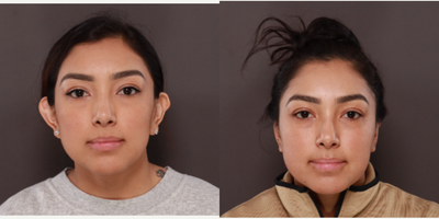 25-34 year old woman treated with Ear Surgery, Earlobe Repair - Otoplasty and earlobe reduction surgery