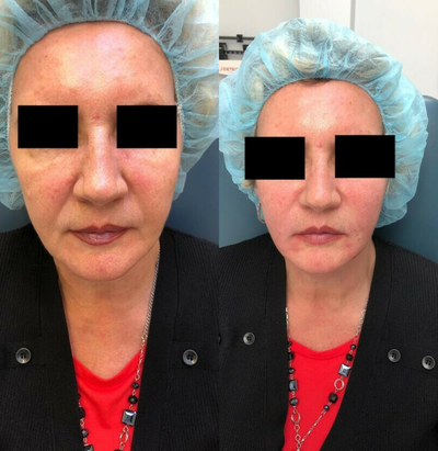 Woman treated with Vampire Facelift - Vampire facelift. Use your own body cells to improve your beauty. Natural facelift.