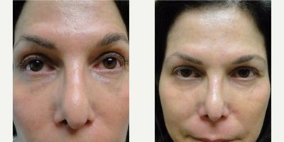 35-44 year old woman treated with Infini RF - Infini treatment by Jeffrey Rapaport, MD Before and after results.