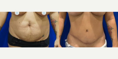 Woman treated with Tummy Tuck - Woman treated with Tummy Tuck