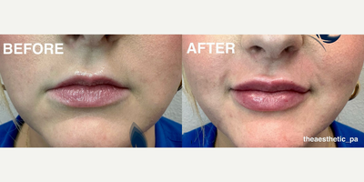 Woman treated with Juvederm - Woman treated with Juvederm