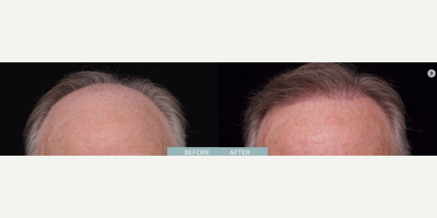 Man treated with NeoGraft - Man treated with NeoGraft