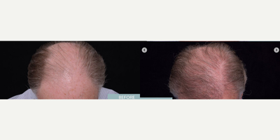 Man treated with NeoGraft - Man treated with NeoGraft