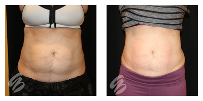 45-54 year old woman treated with Evolve - Before and after Evolve Tite and Evolve Tone combination. Patient was seen over the course of 12 weeks for 12 complete treatments of Evolve Tone. Added additional Tite and Tone treatments after completing 6 Tone treatments alone.  After photo immediately after 12th treatment of Tone (6th treatment of Tite). Overall decrease in submental fat shown and tighter skin elasticity observed.