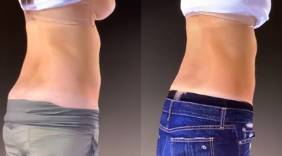 UltraShape - New York's Alizadeh Cosmoplastic Surgery team uses the entirely nonsurgical treatment to reduce bulges for a slimmer look. Contact us to discover how each session is customized to the patient. Link in bio.