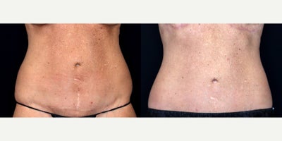 53 year old woman treated with Mini Tummy Tuck - 53 year old woman treated with Mini Tummy Tuck. Photos depict before and 3 months after surgery.