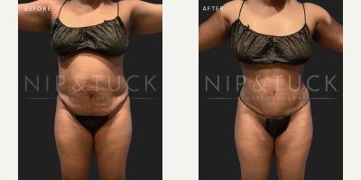 33 year old woman treated with Tummy Tuck and Lipo 360 - 33 y/o female with truncal skin excess and fat deposits seeking improvement of her contour.Weight:165BMI:____Procedure Taken:Abdominoplasty + liposuction 360 4 Months post-op
