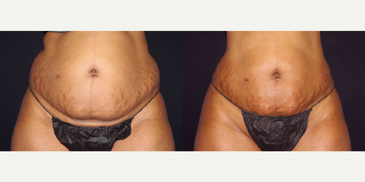 35-44 year old woman treated with Smart Lipo - 38 year old female received Smart Lipo to the abdomen (circumferential); photos depict the patient's results 3 months post-op.