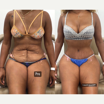 Tummy Tuck - Adam J. Oppenheimer, MD