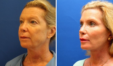Eyelid Surgery before and after photo