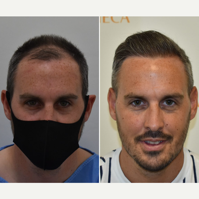 FUE Hair Transplant before and after photo