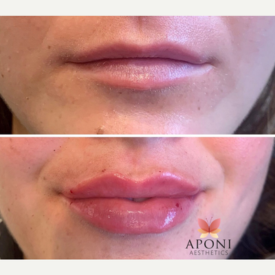 Restylane Silk before and after photo